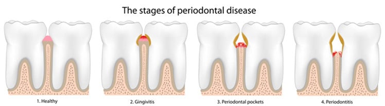 periodontal