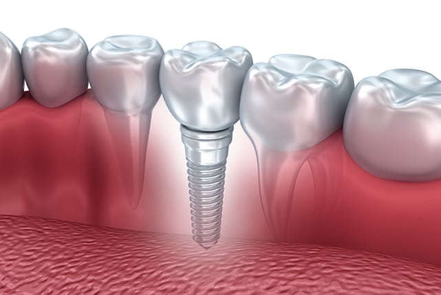 implant-illustration