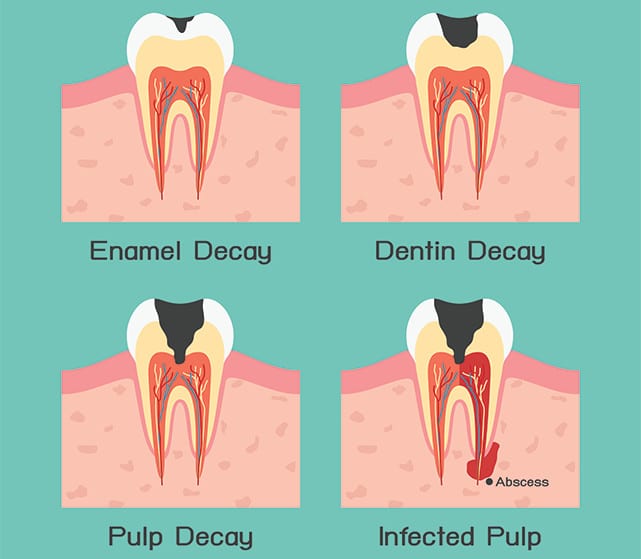 root-canal