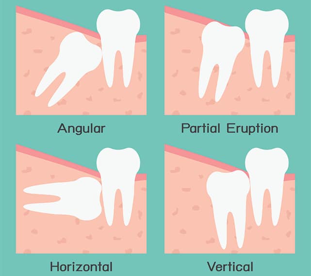 wisdom-teeth