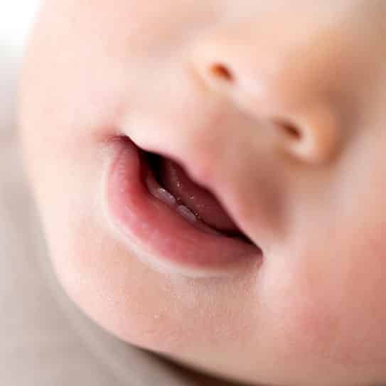 lip tie Fulton frenectomy