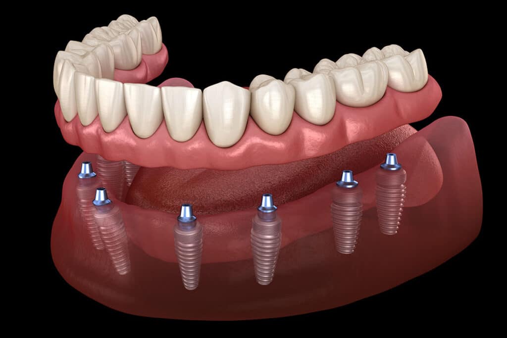 Implant-Retained Dentures dental implants Erie