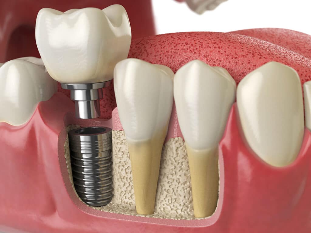 dentist fulton dental implants fulton