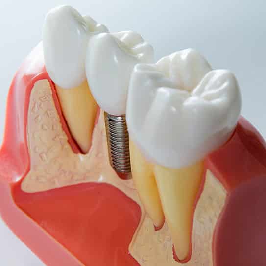 Dental Implants: The Pinnacle of Clinton Dental Restoration