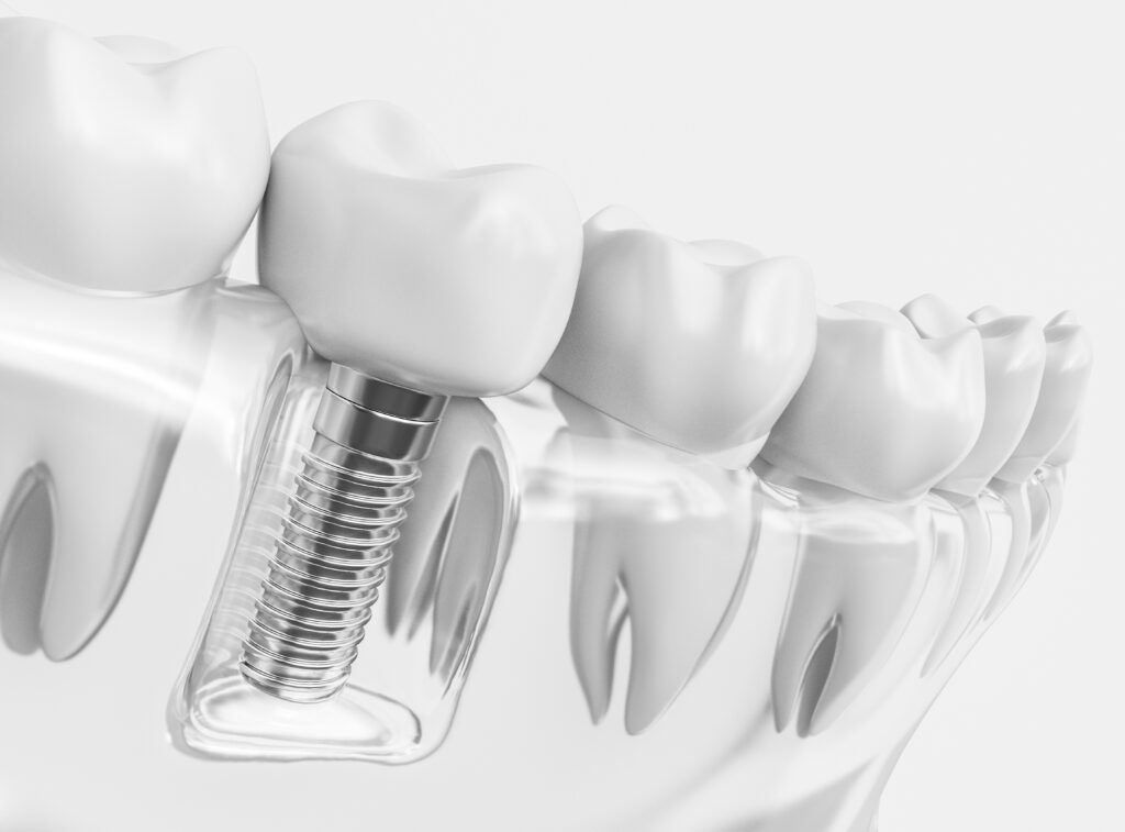 dental implants Clinton