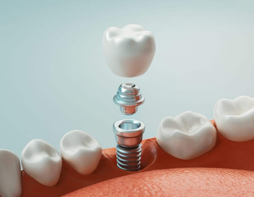 dental implants Fulton